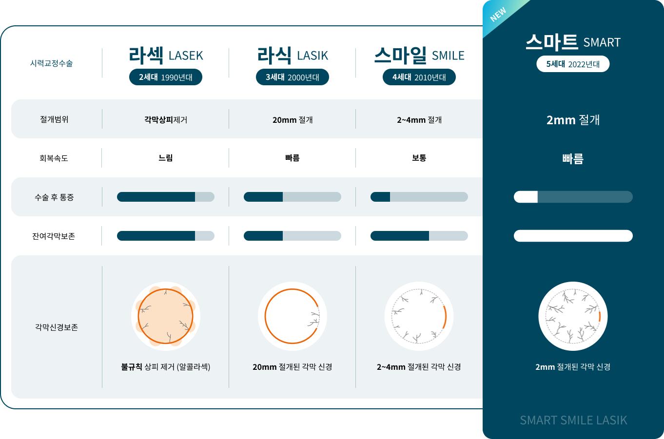 스마일 라식 특징