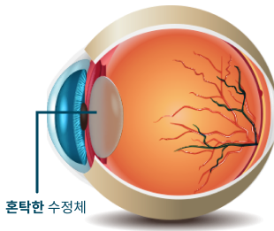 백내장이 있는 눈