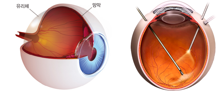 유리체 절제술