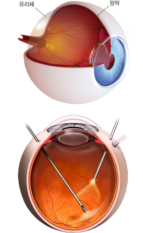 유리체 절제술<